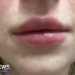 صفقة الجمال: قصة بيكي بيرنز وتحذيرات التجميل "تآكل الأوعية الدموية"
