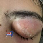 "إنجاز طبي نادر بالأزهر بأسيوط.. استخراج قطعة زجاج وإعادة البصر بعد 10 سنوات"