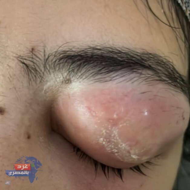 "إنجاز طبي نادر بالأزهر بأسيوط.. استخراج قطعة زجاج وإعادة البصر بعد 10 سنوات"