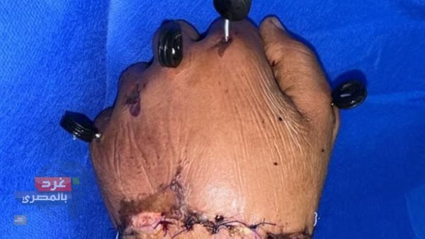 إعادة زراعة يد مبتورة بعد عملية استغرقت 12 ساعة" بجامعة الزقازيق